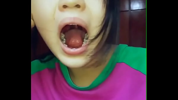 Asian Girl Showing her Teeth Cavities