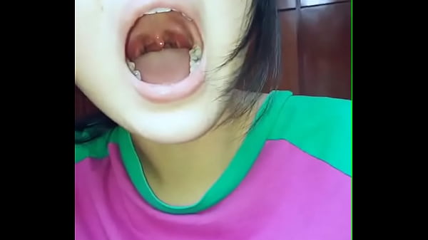Asian Girl Showing her Teeth Cavities