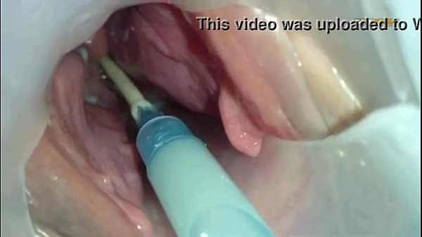 Download Video - Sperm injected into the uterus of the wife of others